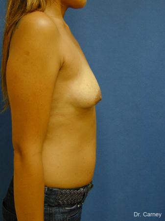 Virginia Beach Breast Augmentation 1860 - Before Image 3