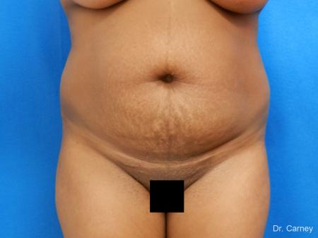 Abdominoplasty: Patient 1 - Before Image 3