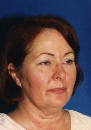 Virginia Beach Laser Skin Resurfacing - Face - Before Image 1