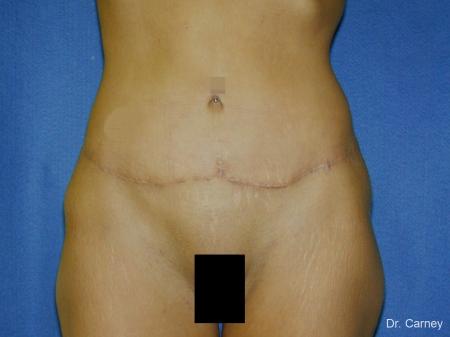 Tummy Tuck: Patient 1 - After Image 1