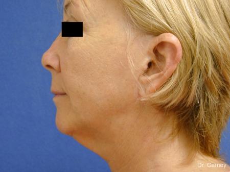 Virginia Beach Laser Skin Resurfacing Face 1263 - Before and After Image 4