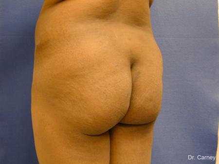 Virginia Beach Brazilian Butt Lift 1220 - Before Image 3