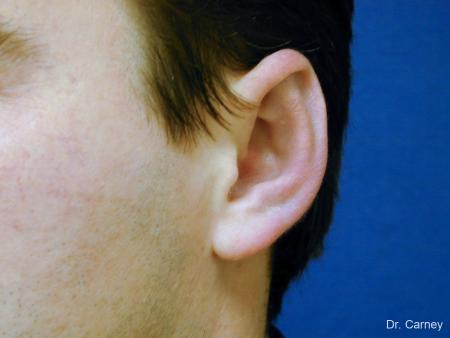 Virginia Beach Otoplasty Earlobe Repair 1237 - After Image 3