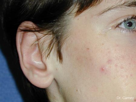 Virginia Beach Otoplasty Earlobe Repair 1271 - After Image 4
