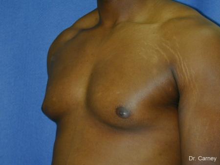 Virginia Beach Gynecomastia 1226 - Before Image 3
