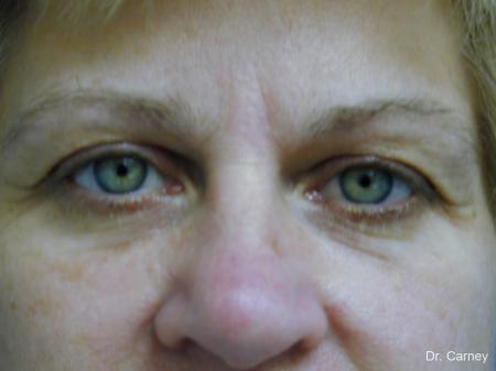 Virginia Beach Eyelid Lift 1344 - Before Image 2
