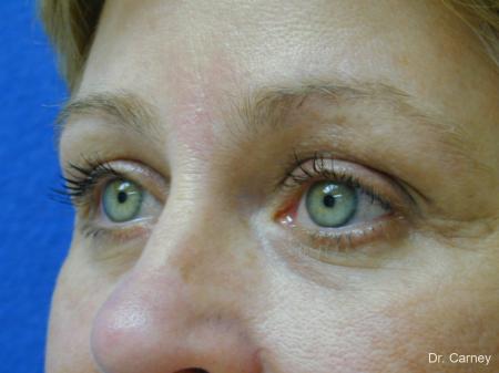 Virginia Beach Brow Lift 1345 - After Image 3