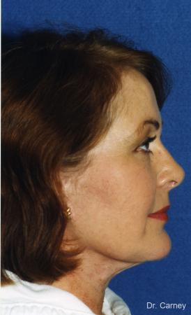 Virginia Beach Laser Skin Resurfacing - Face - After Image 3