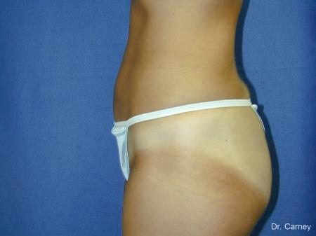 Virginia Beach Liposuction 1282 - After Image 5