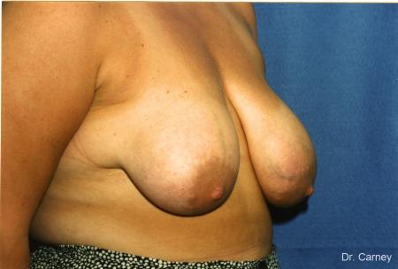 Virginia Beach Breast Lift 1190 - Before Image 1