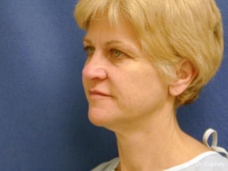 Virginia Beach Facelift 1346 - Before Image 3