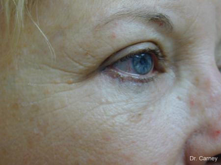 Virginia Beach Brow Lift 1266 - Before Image 4