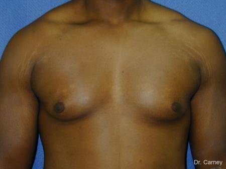 Virginia Beach Gynecomastia 1226 - Before Image 1