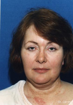 Virginia Beach Laser Skin Resurfacing - Face - Before Image 2