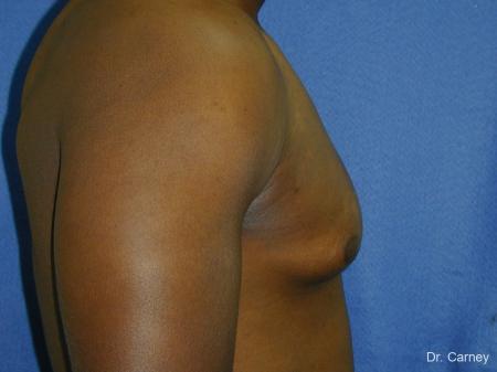 Virginia Beach Gynecomastia 1226 - Before Image 4