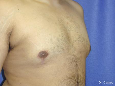 Virginia Beach Gynecomastia 1255 - After Image 3