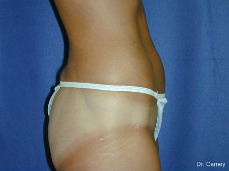 Virginia Beach Liposuction 1282 - After Image 3