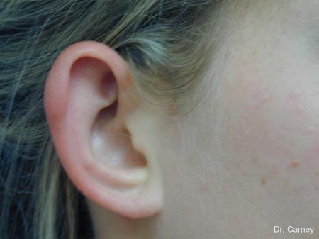Virginia Beach Otoplasty Earlobe Repair 1223 - Before and After Image 4