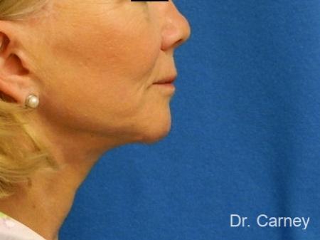 Virginia Beach Neck Lift 1264 - After Image 2