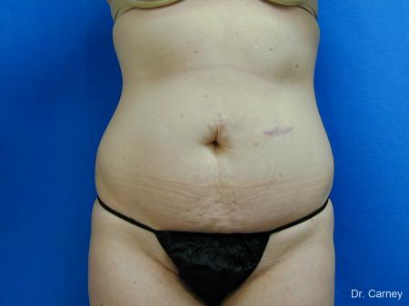 Virginia Beach Tummy Tuck 1251 - Before Image 1