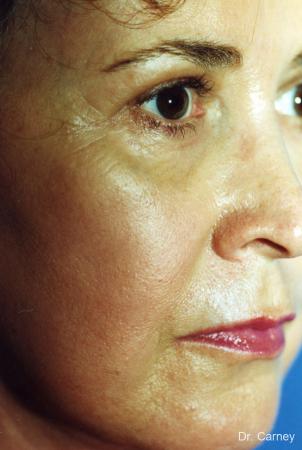 Virginia Beach Laser Skin Resurfacing - Face 1259 - After Image 3