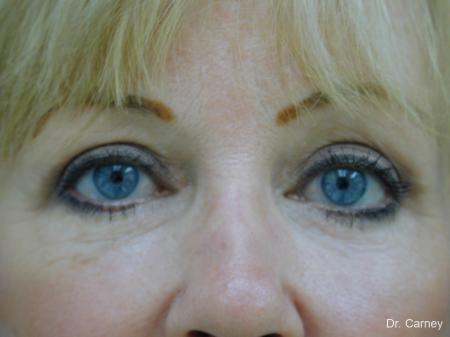 Virginia Beach Brow Lift 1266 - After Image 3