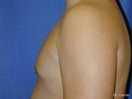 Virginia Beach Gynecomastia - After Image 4