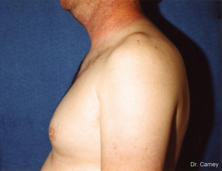 Virginia Beach Gynecomastia 1227 - Before and After Image 2