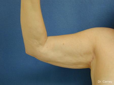 Virginia Beach Brachioplasty 1144 - After Image 3