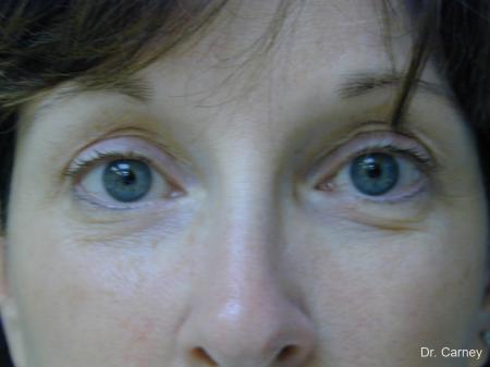 Virginia Beach Brow Lift 1217 - After Image 2