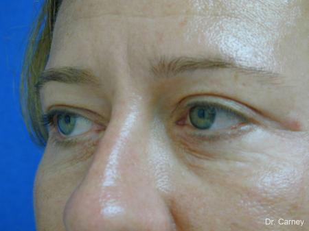 Virginia Beach Eyelid Lift 1209 - After Image 3
