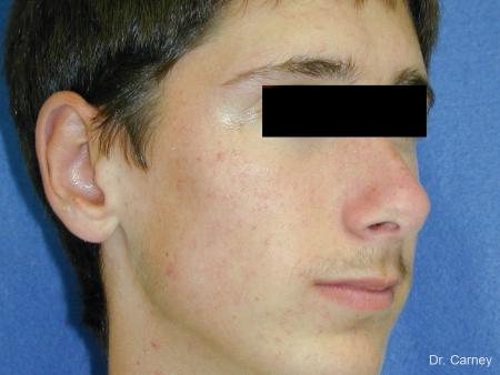 Virginia Beach Otoplasty Earlobe Repair 1271 - After Image 2