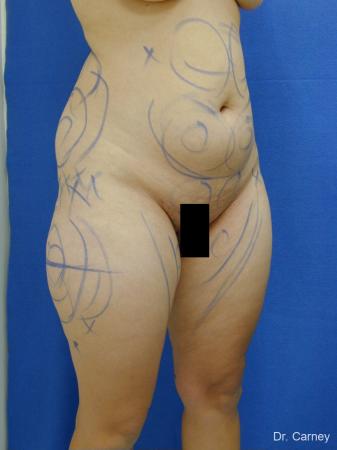 Virginia Beach Liposuction 1284 - Before and After Image 5