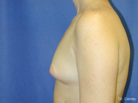 Virginia Beach Breast Augmentation 1090 - Before Image 1