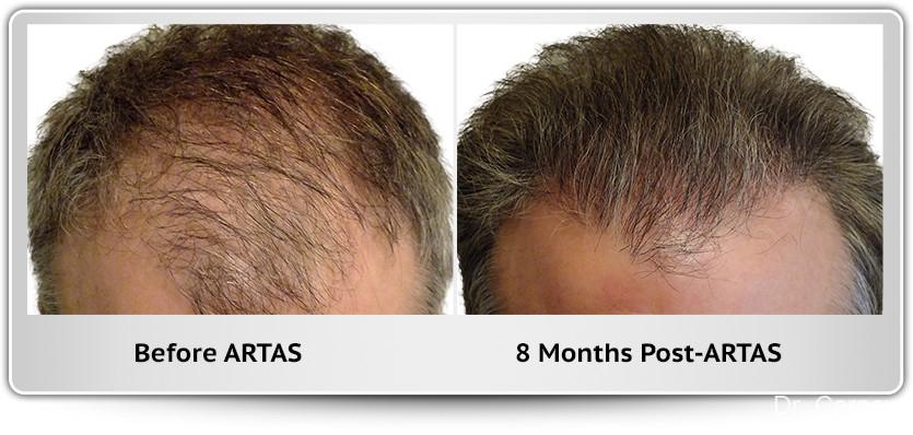 Hair Transplantation: Patient 8 - Before and After 1