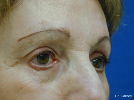 Virginia Beach Eyelid Lift 1128 - Before and After Image 2