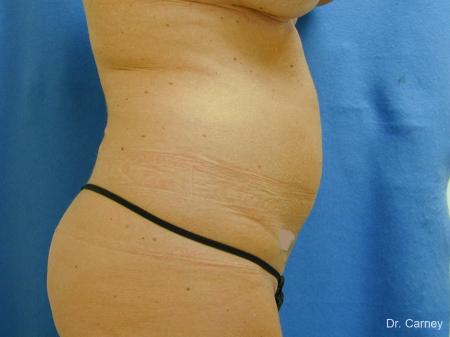 Virginia Beach Liposuction 1279 - Before Image 2