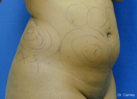 Virginia Beach Liposuction 1283 - Before and After Image 4