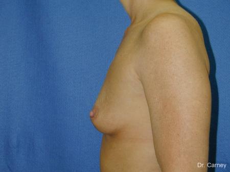 Virginia Beach Breast Augmentation 1081 - Before Image 1