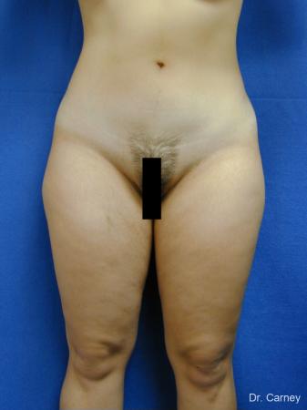 Virginia Beach Liposuction 1285 - Before Image 2