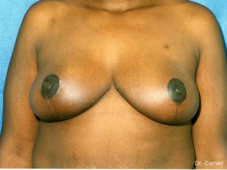 Virginia Beach Breast Lift 1189 - After Image 1