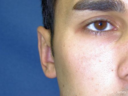 Virginia Beach Otoplasty Earlobe Repair 1222 - After Image 1