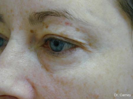 Virginia Beach Eyelid Lift 1138 - Before and After Image 3