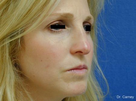 Virginia Beach Rhinoplasty 1343 - Before Image 3