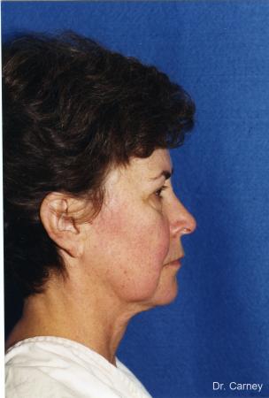 Virginia Beach Laser Skin Resurfacing - Face 1259 - Before Image 2