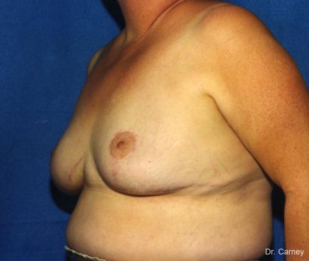 Virginia Beach Breast Lift 1186 - After Image 3