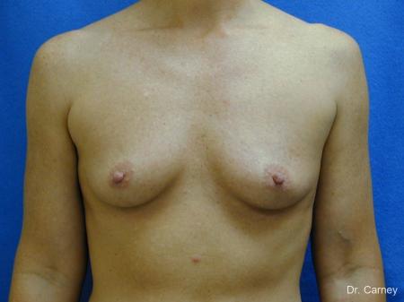 Virginia Beach Breast Augmentation 1214 - Before Image 1