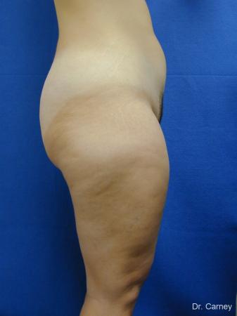 Virginia Beach Liposuction 1285 - Before Image 4