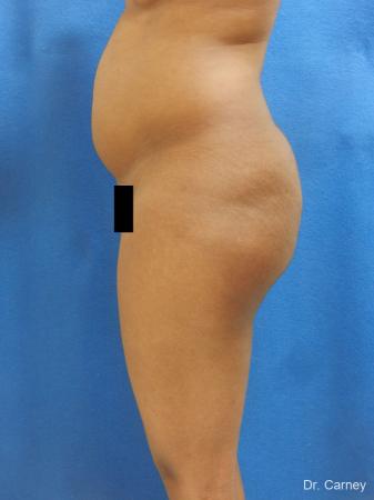 Brazilian Butt Lift: Patient 6 - Before Image 1