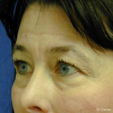 Virginia Beach Eyelid Lift 1139 - Before and After Image 3
